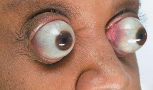 The 15-Year-Old Boy with the Body of an Old Man: 10 People Who Look Like Real-Life Aliens